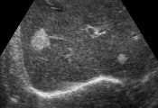 Izgled jetre na ultrazvuku